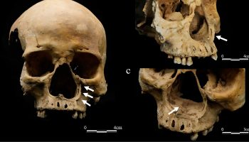 In China, a skeleton bears witness to an ancient punishment