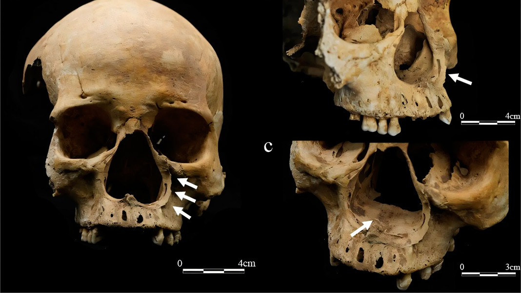 In China, a skeleton bears witness to an ancient punishment